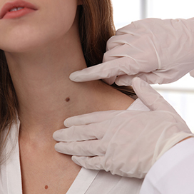 5 incorrect theories about skin tags